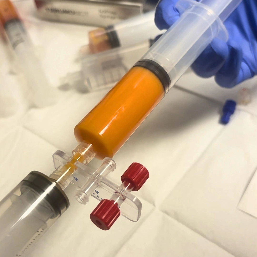 Adipose-derived stem cell therapy preparation for rotator cuff tears at Dr. Bhandari's clinic in Bellevue WA